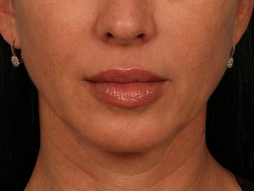 Injectable Fillers Before & After Image