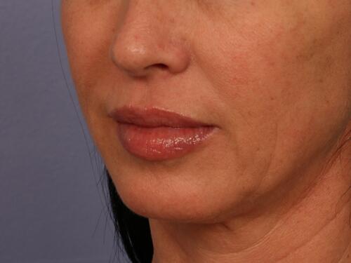 Injectable Fillers Before & After Image