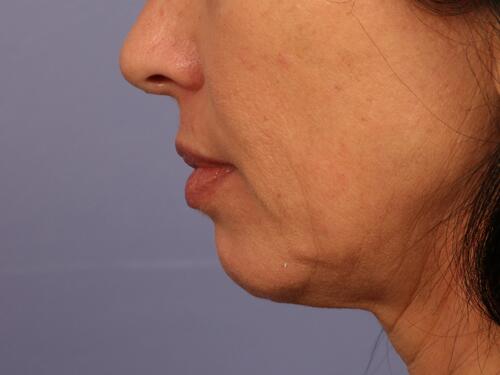 Injectable Fillers Before & After Image