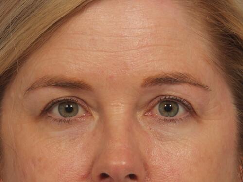 Injectable Fillers Before & After Image