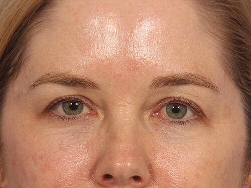 Injectable Fillers Before & After Image