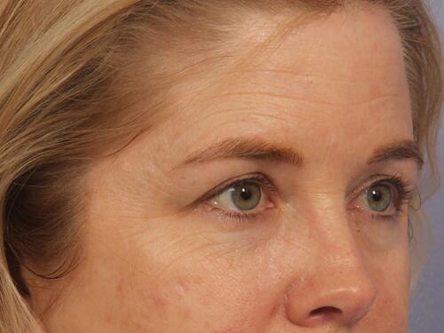 Injectable Fillers Before & After Image