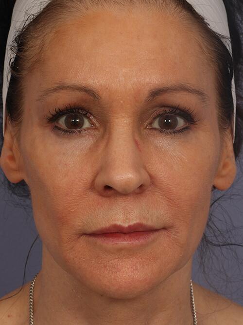 Injectable Fillers Before & After Image