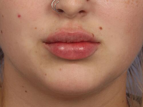 Injectable Fillers Before & After Image