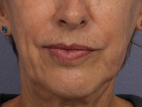 Injectable Fillers Before & After Image