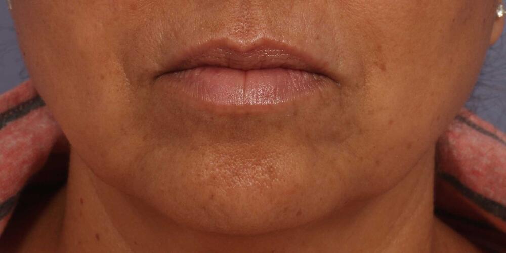 Injectable Fillers Before & After Image