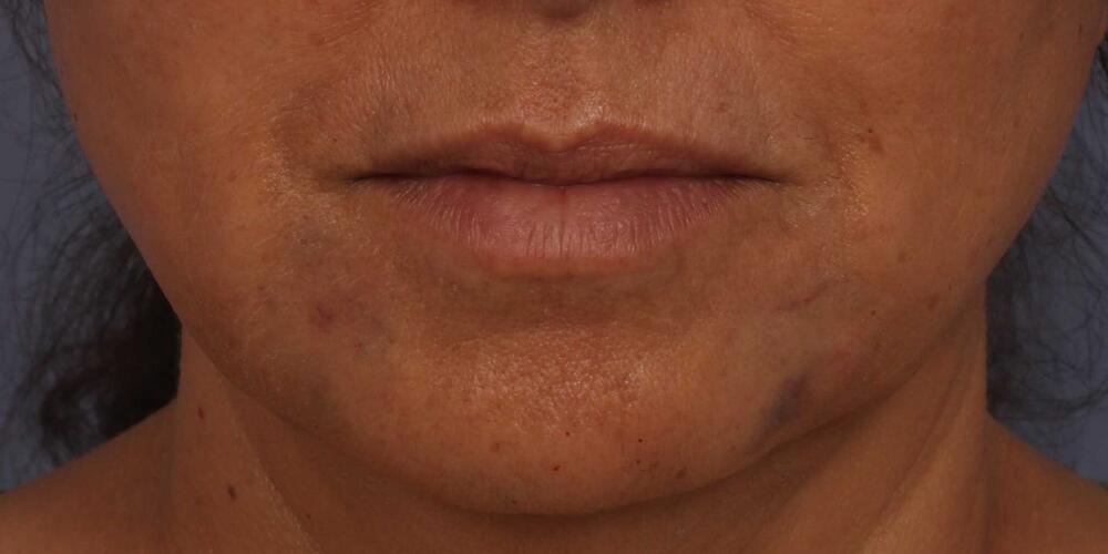 Injectable Fillers Before & After Image