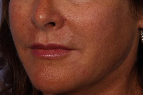 Injectable Fillers Before & After Image