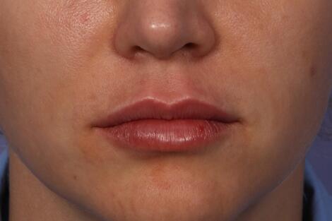 Injectable Fillers Before & After Image