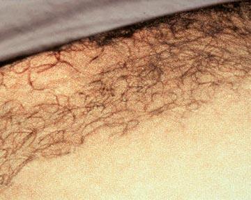 Laser Hair Removal Before & After Image