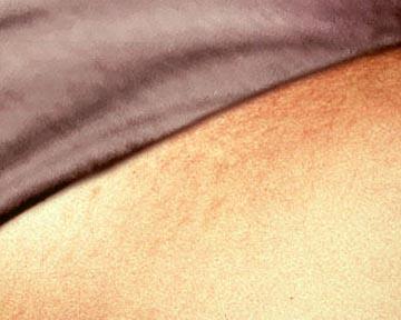 Laser Hair Removal Before & After Image