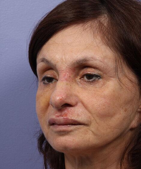 Laser Skin Resurfacing Before & After Image