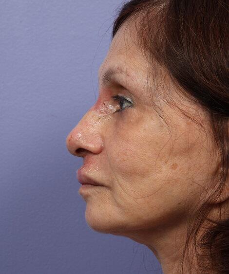 Laser Skin Resurfacing Before & After Image