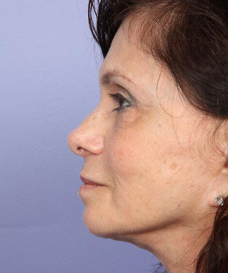 Laser Skin Resurfacing Before & After Image