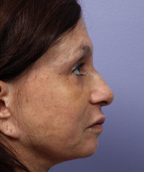 Laser Skin Resurfacing Before & After Image