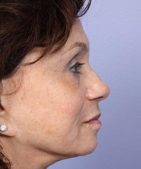 Laser Skin Resurfacing Before & After Image