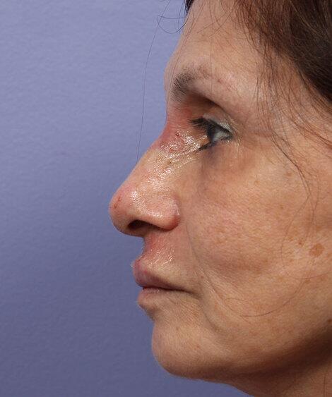 Laser Skin Resurfacing Before & After Image