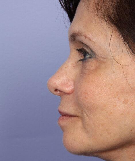 Laser Skin Resurfacing Before & After Image