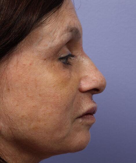 Laser Skin Resurfacing Before & After Image