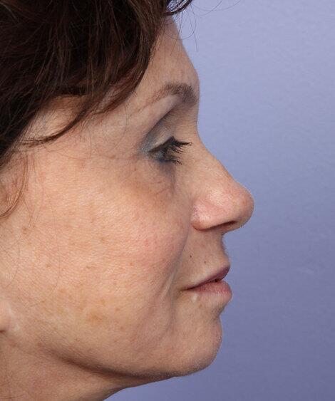 Laser Skin Resurfacing Before & After Image