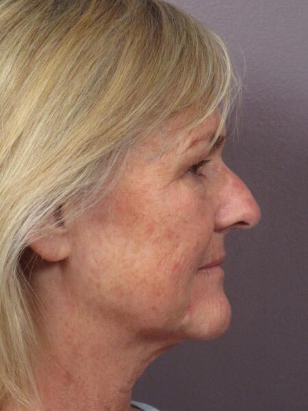 Laser Skin Resurfacing Before & After Image