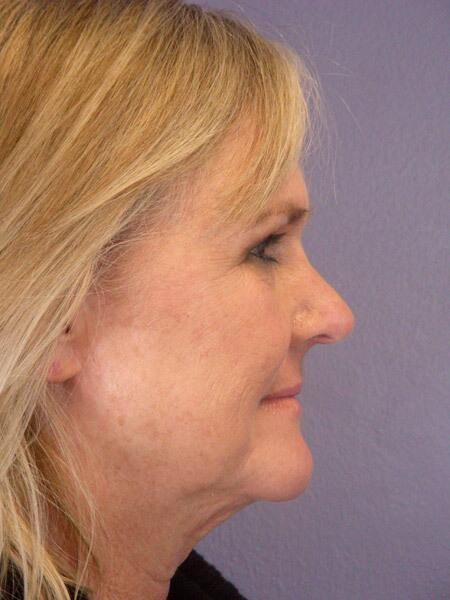 Laser Skin Resurfacing Before & After Image