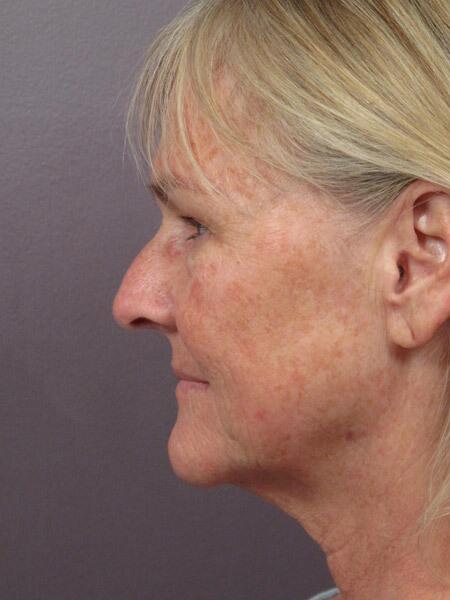 Laser Skin Resurfacing Before & After Image