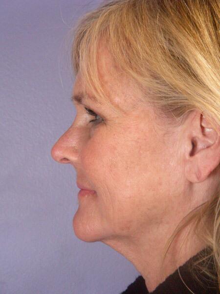 Laser Skin Resurfacing Before & After Image