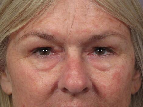 Laser Skin Resurfacing Before & After Image