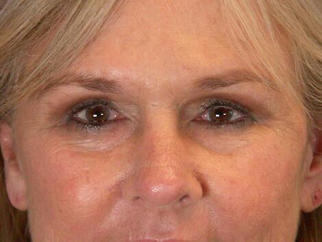 Laser Skin Resurfacing Before & After Image