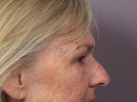 Laser Skin Resurfacing Before & After Image