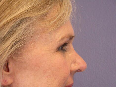 Laser Skin Resurfacing Before & After Image