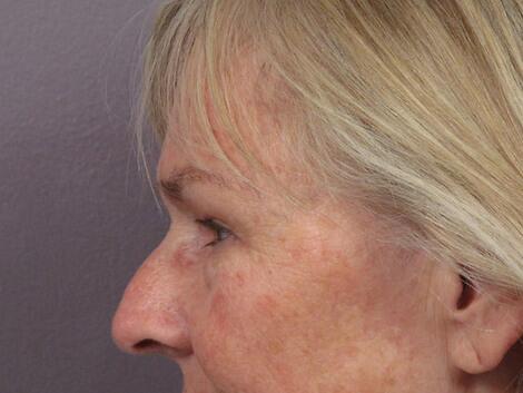 Laser Skin Resurfacing Before & After Image