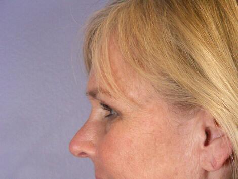 Laser Skin Resurfacing Before & After Image