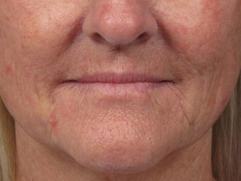 Laser Skin Resurfacing Before & After Image