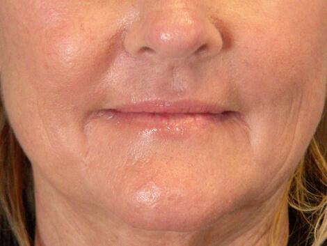 Laser Skin Resurfacing Before & After Image