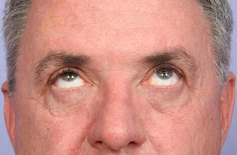 Laser Skin Resurfacing Before & After Image