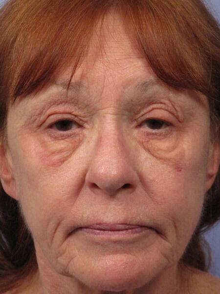 Laser Skin Resurfacing Before & After Image