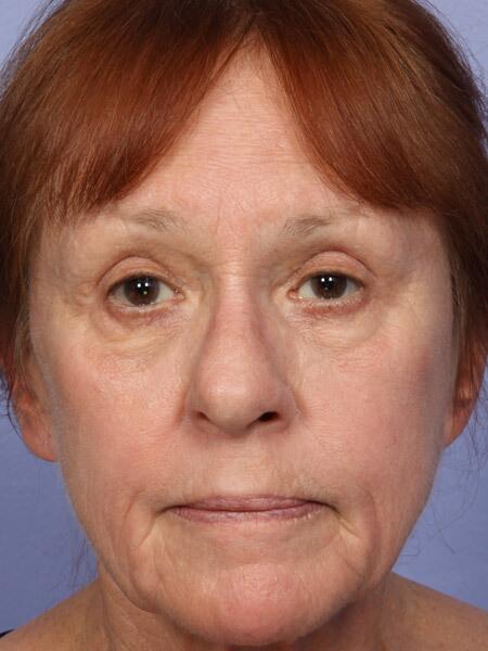 Laser Skin Resurfacing Before & After Image