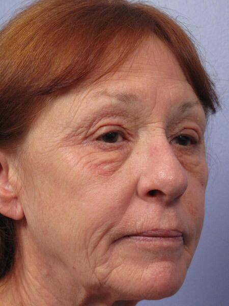 Laser Skin Resurfacing Before & After Image