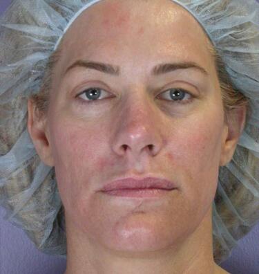 Laser Skin Resurfacing Before & After Image