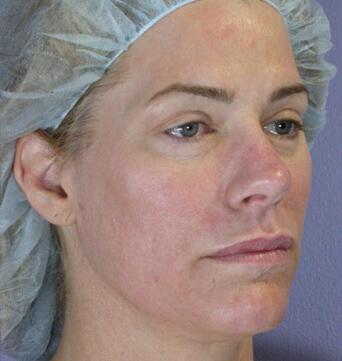 Laser Skin Resurfacing Before & After Image