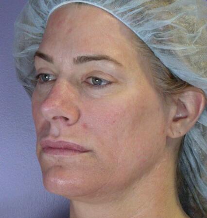 Laser Skin Resurfacing Before & After Image