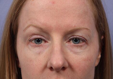 Laser Skin Resurfacing Before & After Image