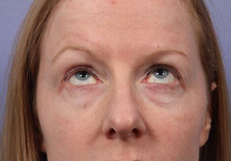 Laser Skin Resurfacing Before & After Image