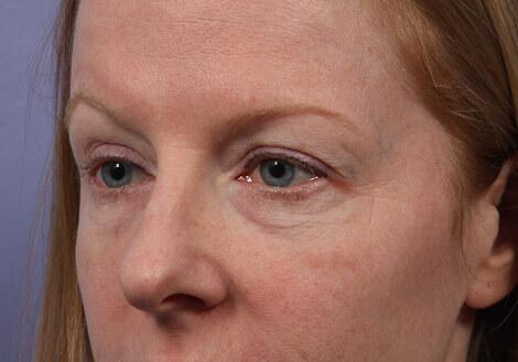 Laser Skin Resurfacing Before & After Image