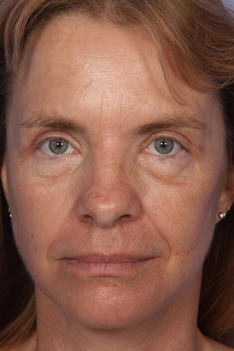 Laser Skin Resurfacing Before & After Image