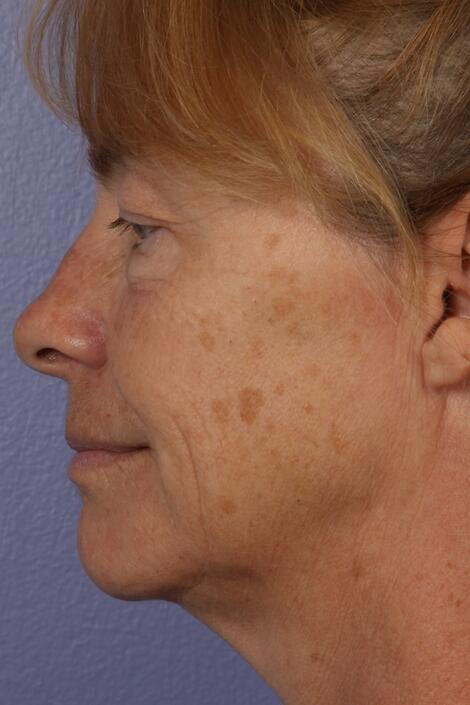 Laser Skin Resurfacing Before & After Image