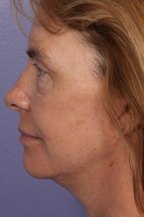 Laser Skin Resurfacing Before & After Image