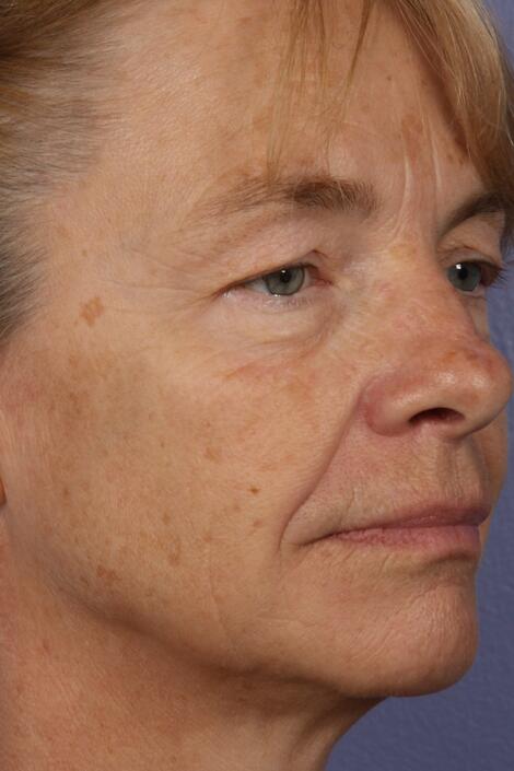 Laser Skin Resurfacing Before & After Image